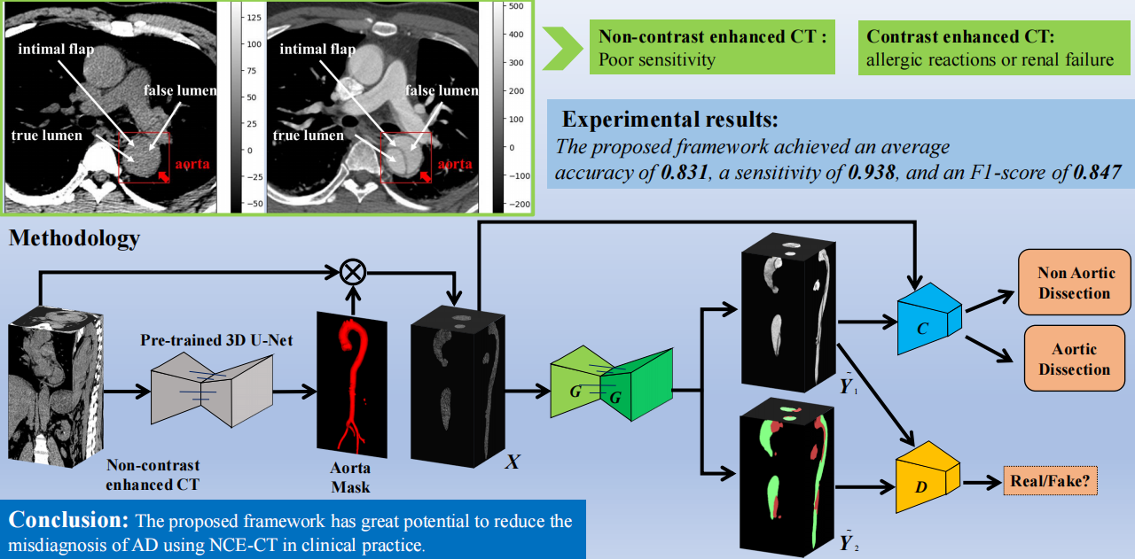 Scientific visual abstract showing aorta segmentation, image synthesis, lumen segmentation, discriminator, and classification