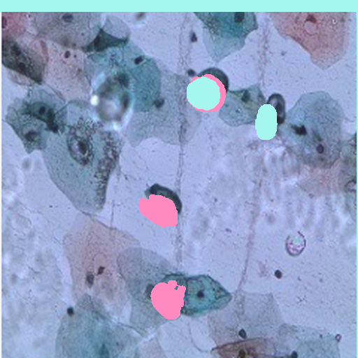 Cervical cytology sample with segmentation overlay