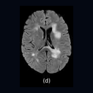FLAIR MRI example