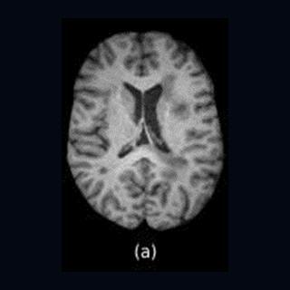 T1-weighted MRI example