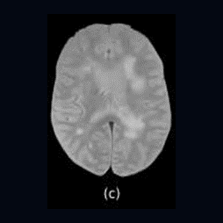 Contrast-enhanced T1 MRI example