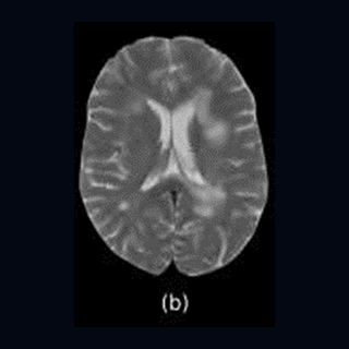 T2-weighted MRI example