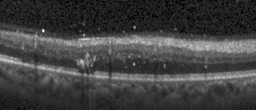 Animated retinal OCT B-scan