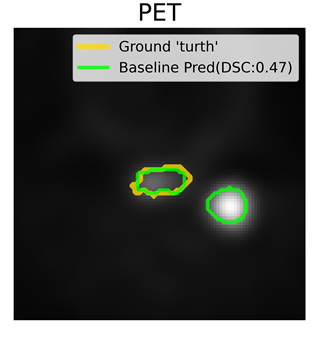 Baseline PET prediction