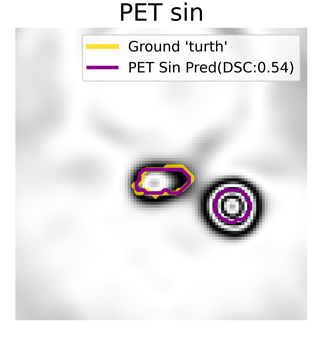 PET sin prediction