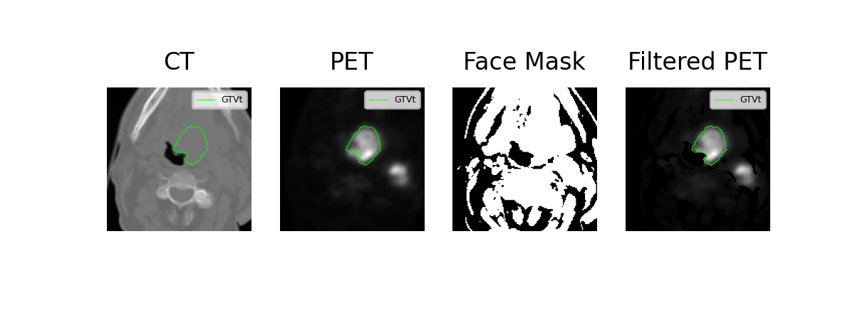 Face mask filtered PET workflow