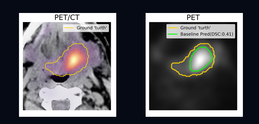 PET and CT head and neck tumor views