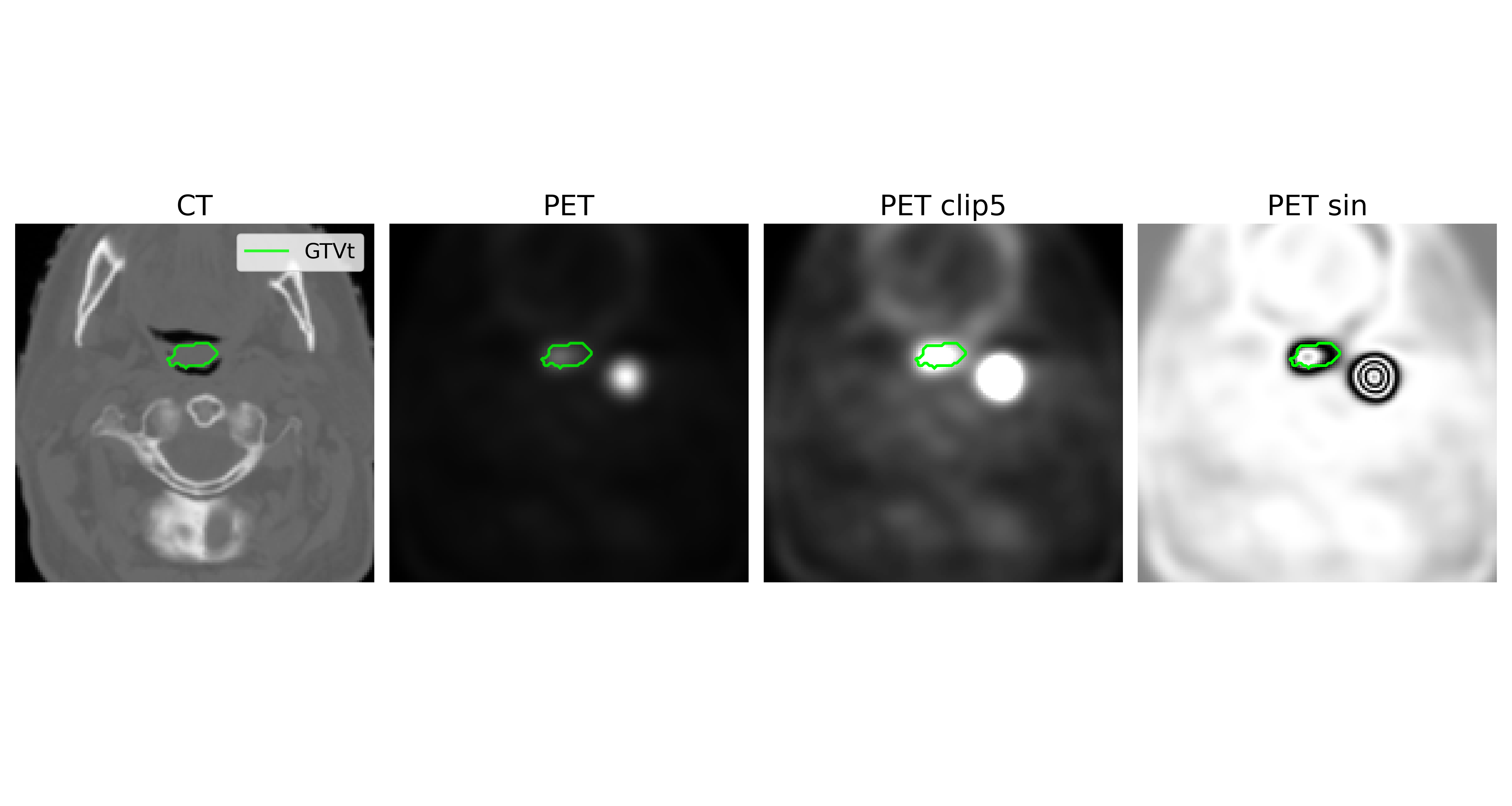 PET clipping workflow