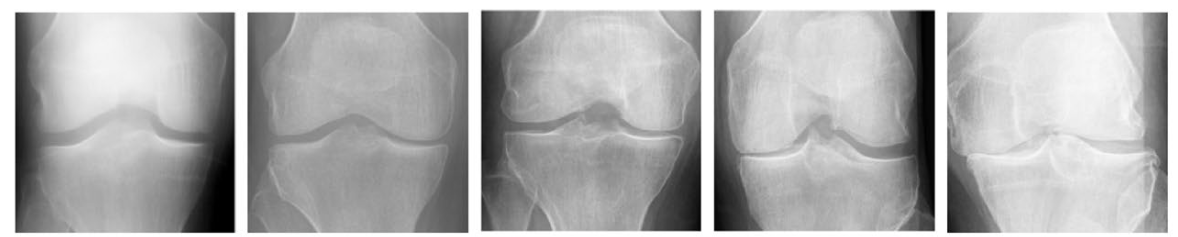 Original knee X-rays across KL grades