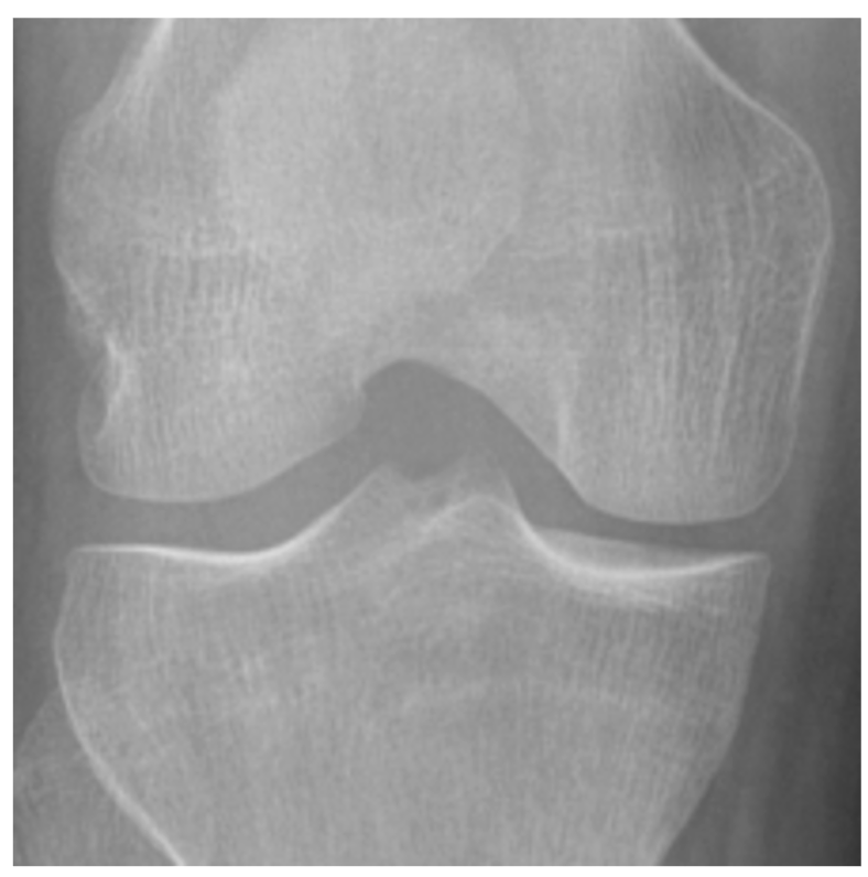 Knee X-ray for KL grade 0
