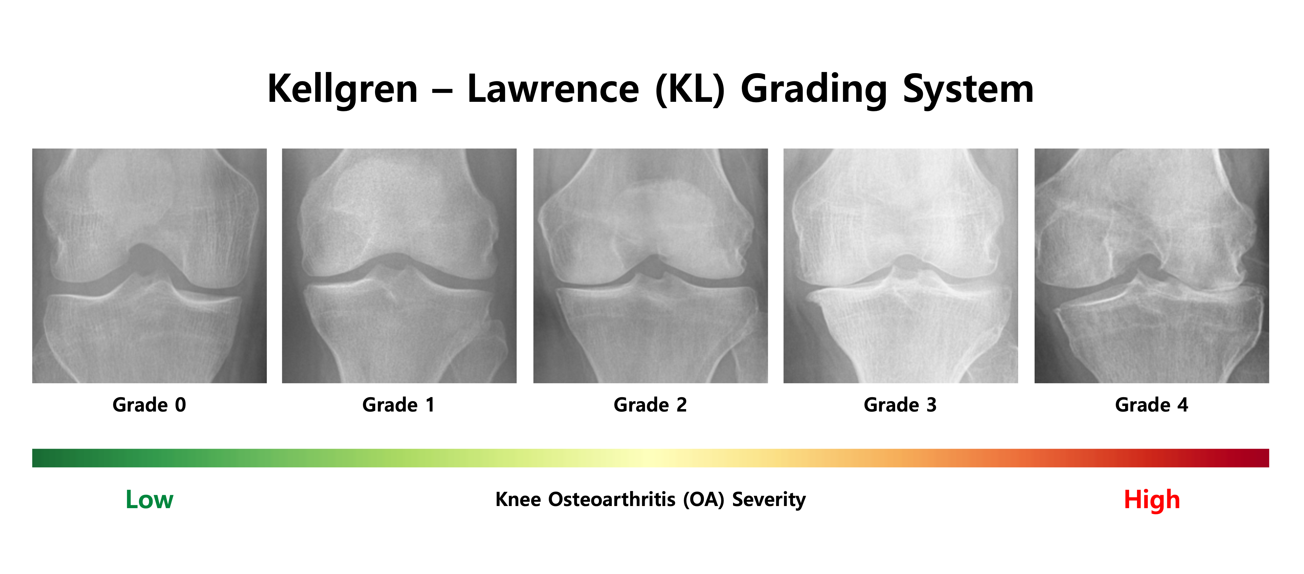 Kellgren-Lawrence grade spectrum from grade 0 to grade 4
