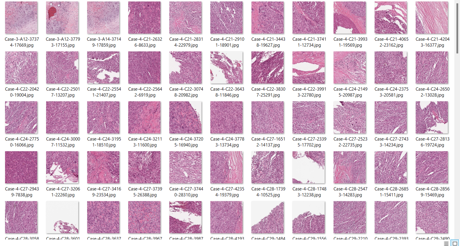 Viable tumor histology dataset tiles