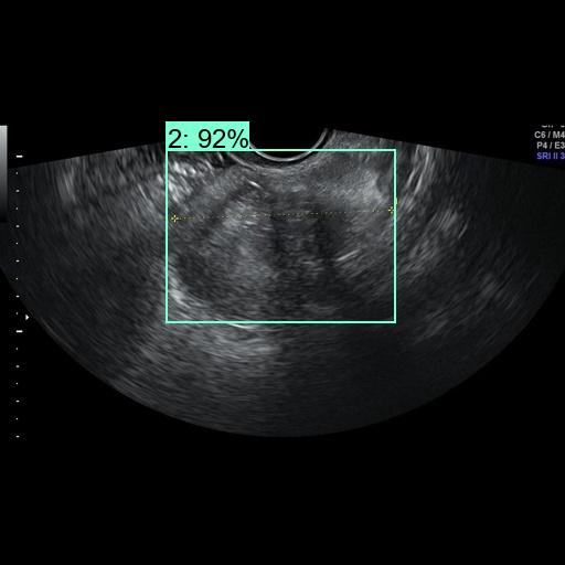Ovarian ultrasound detection example