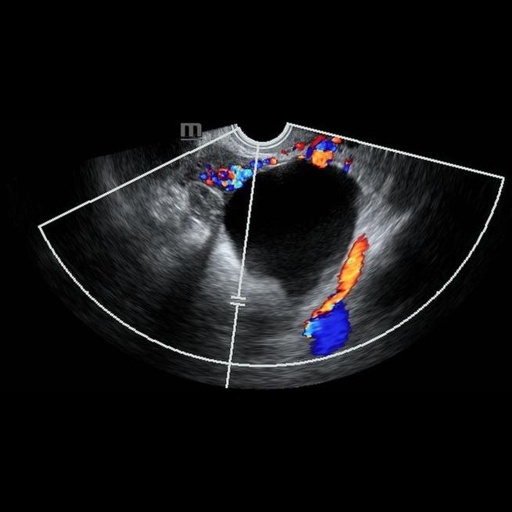 Original ovarian ultrasound